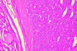 甲状旁腺功能减退症