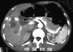 脑血管畸形
