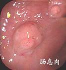 小儿消化性溃疡 小儿消化性溃疡