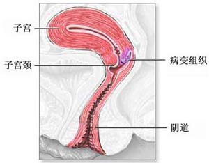 子宫息肉 子宫息肉