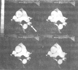 脂肪栓塞综合征